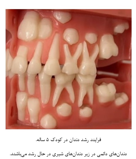 از دست رفتن زودهنگام دندان شیری کودکان