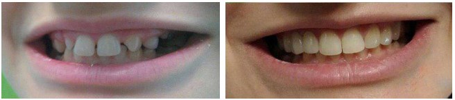 اصلاح طرح لبخند
