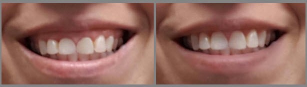اصلاح طرح لبخند