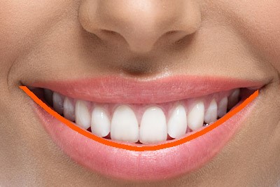 اصلاح طرح لبخند