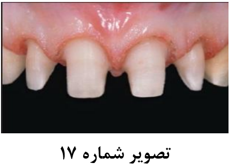 فرایندهای مختلف افزایش طول تاج دندان