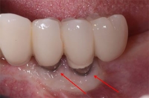 عفونت ایمپلنت های دندانی