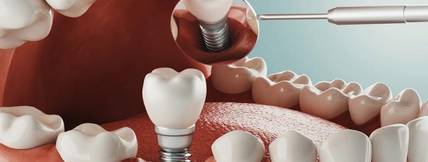 سن کاشت ایمپلنت دندانی
