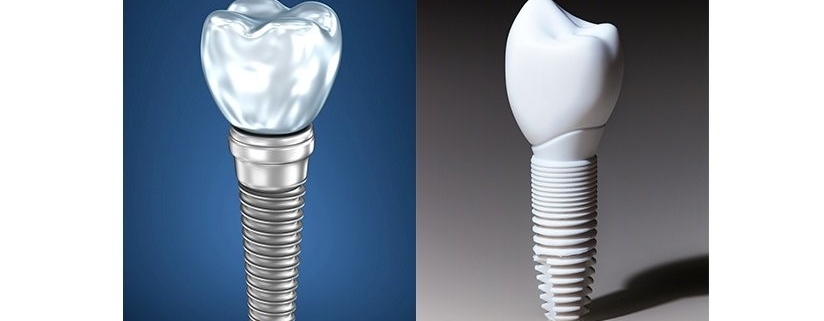 مقایسه ایمپلنت های دندانی زیرکونیا و تیتانیومی