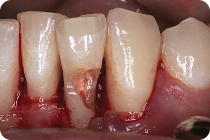 تحلیل ریشه دندان