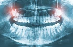 عفونت سینوس و دندان درد