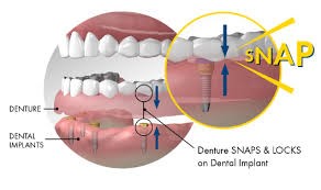 مقایسه پروتز دندانی دائمی و متحرک