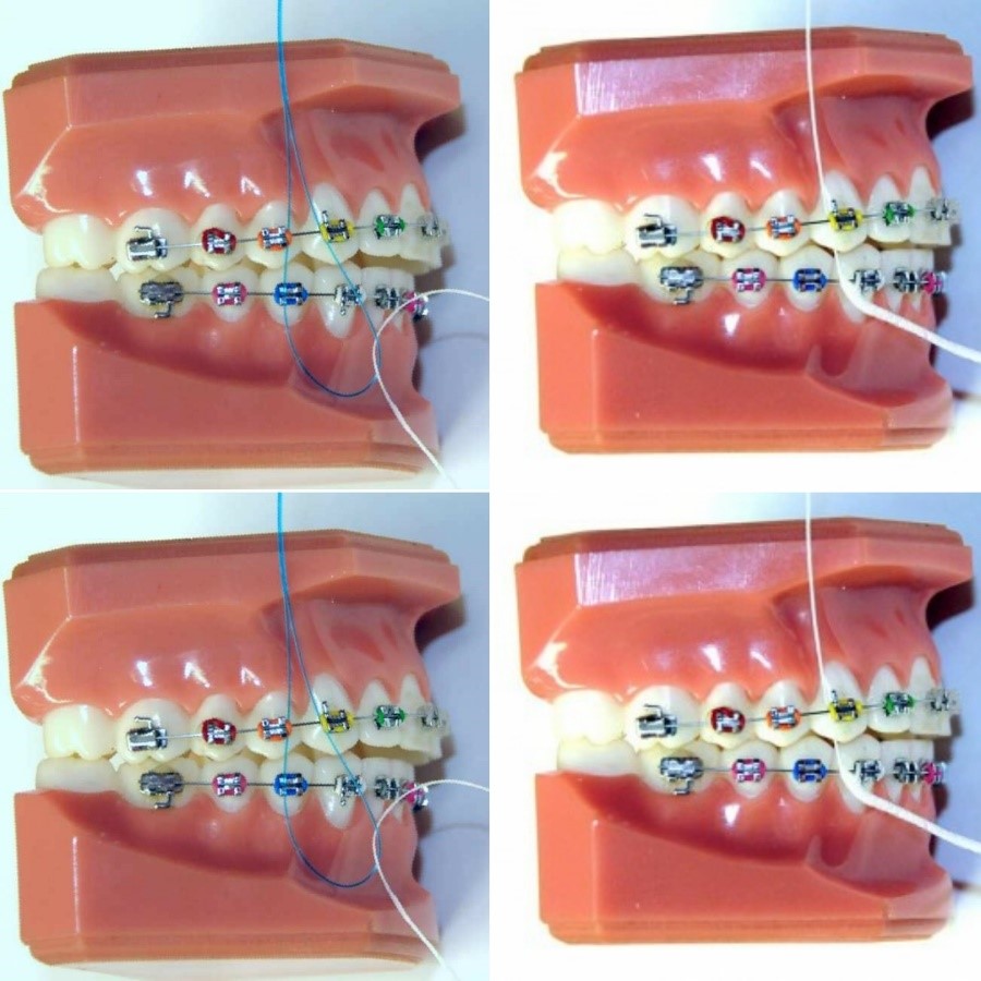 نخ دندان کشیدن حین ارتودنسی