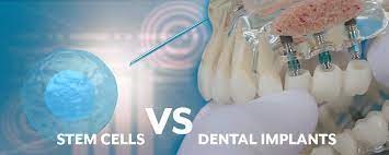 ایمپلنت های دندانی با سلول های بنیادی