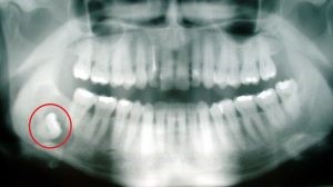 نقش دندان های مولر