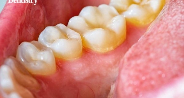 مضرات سیگار الکترونیک برای دندان