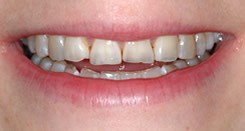 عوارض دندانی اختلال پرخوری