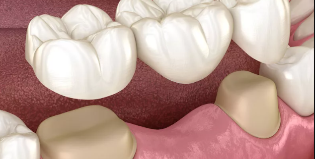 مقایسه ایمپلنت های دندانی و بریج ها
