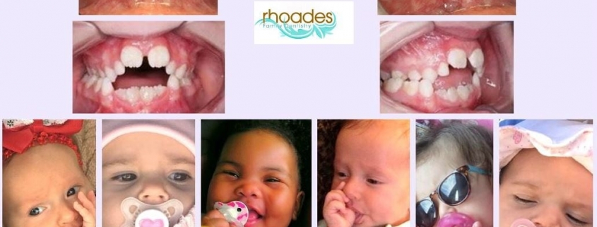 تاثیر مکیدن پستانک بر دندان و فک کودکان