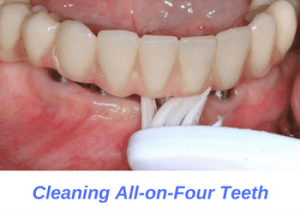 پاکسازی پروتزهای دندانی All- on- 4