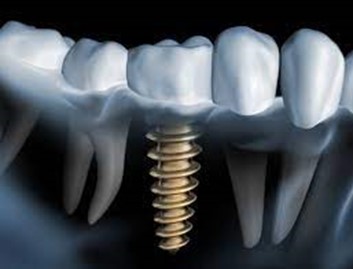 حساسیت ایمپلنت دندانی
