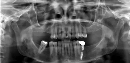 اشتباهات در کاشت ایمپلنت دندانی