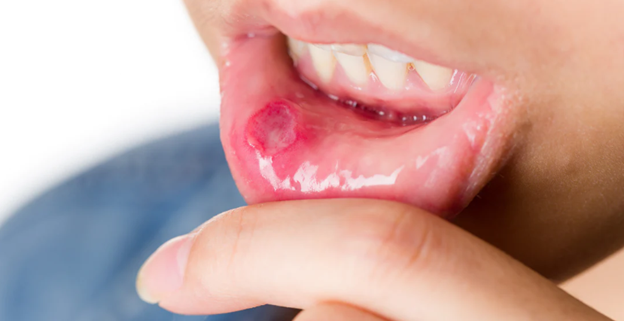 درمان زخم و ضایعات دهانی