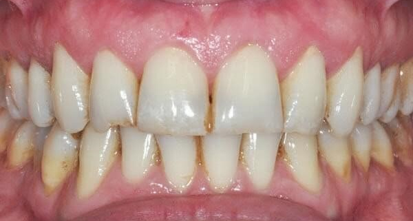 سفید کردن تخصصی دندان ها