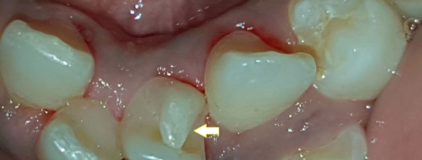 اثرات کاسپ تالون بر سلامت دندانی