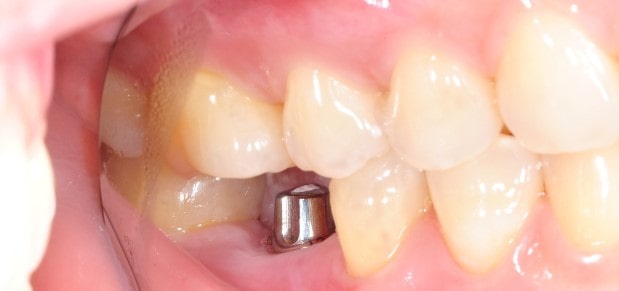 سفید کردن تخصصی روکش های ایمپلنت های دندانی