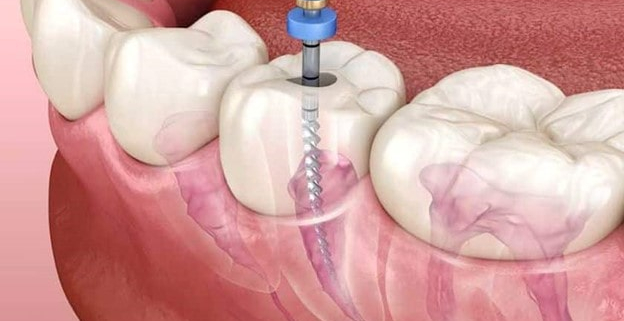 نگهداری از دندان بعد از درمان ریشه