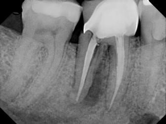 علل ترک خوردگی دندان زیر روکش دندان