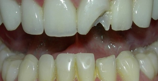 علائم و نشانه های ترک خوردگی دندان