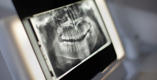 انواع عکس رادیوگرافی با اشعه ایکس مورد استفاده برای بیماری لثه