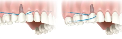 آیا باید ایمپلنت های دندانی خود را نخ دندان بکشید؟