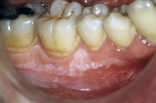 آیا همه لوکوپلاکیاهای مشکوک باید نمونه برداری شوند؟
