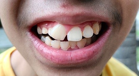 اقدامات پیشگیرانه برای جلوگیری از تغییر رنگ دندان ها