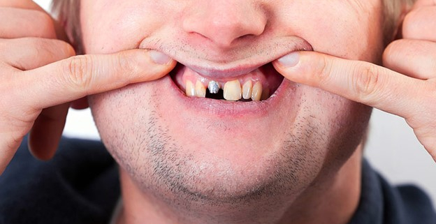 مدیریت یک بریج شل روی ایمپلنت دندانی تا زمانی که بتوانید به دندانپزشک مراجعه کنید.