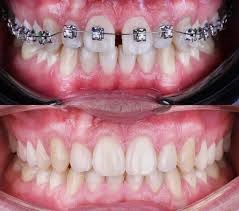 مواردی که می توانند بریس روی یک فک داشته باشید.