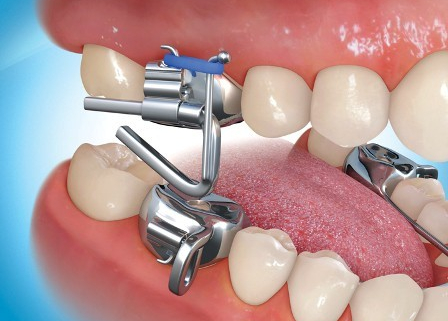 نحوه عملکرد رشد هدایت شده